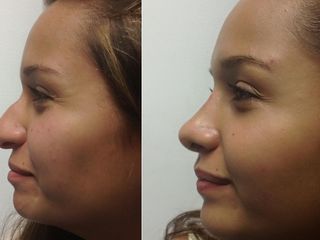 Antes y despues de rinoplastia