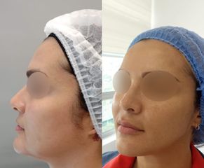 Rejuvenecimiento facial - Dra. Laura Astorquiza A.