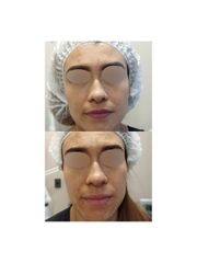 Rejuvenecimiento Facial - Dra. Laura Astorquiza A.