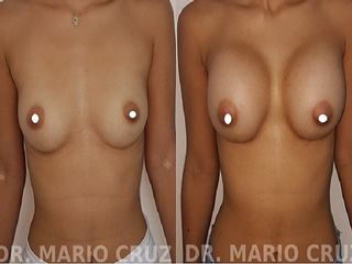 Mamoplastia de aumento