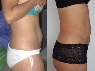 Lipoescultura