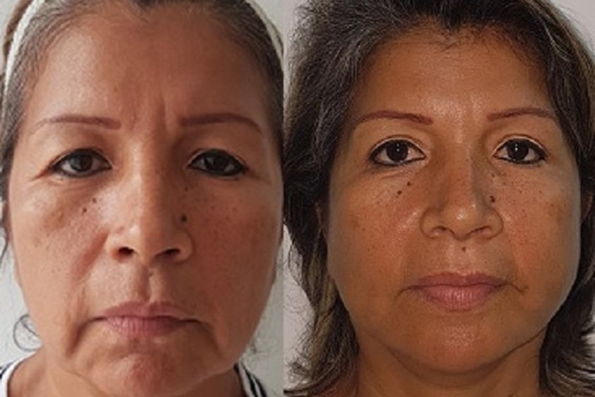Lifting facial antes y después - 623519