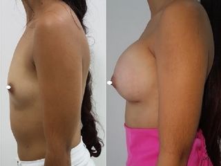 MAMOPLASTIA DE AUMENTO