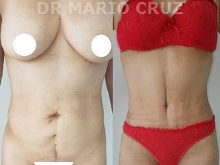 ABDOMINOPLASTIA FRONTAL CLINICAS ESTETICAS