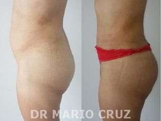 ABDOMINOPLASTIA LATERAL MAS LIPOINYECCION GLUTEA CE