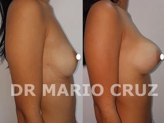 MAMOPLASTIA DE AUMENTO ABORDAJE SUBMAMARIO 