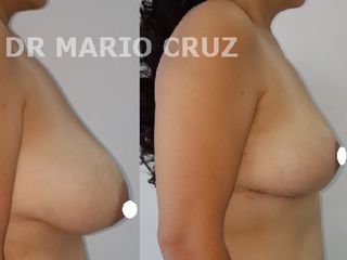 MAMOPLASTIA DE REDUCCIÓN