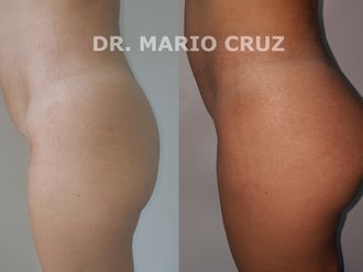Gluteoplastia - 646429