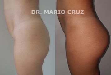 Gluteoplastia
