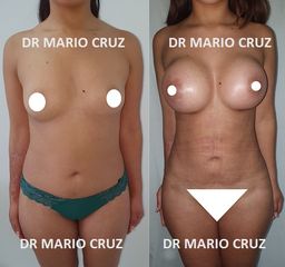 mamoplastia de aumento más lipoescultura y lipotransferencia glútea(mommy makeover)