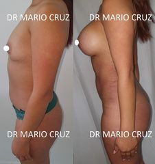 Mamoplastia de aumento por vía submamaria más lipoescultura más lipotransferencia glútea