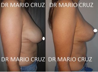 Pexia mamaria sin implantes