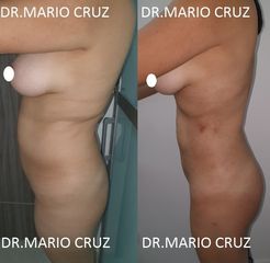 Lipoescultura lateral