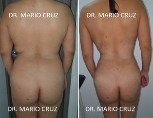 Lipoescultura posterior