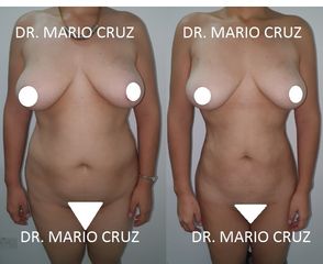 Lipoescultura frontal