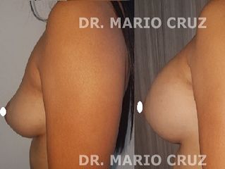 Mamoplastia de aumento abordaje inframamario lateral