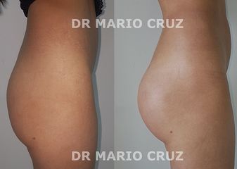Aumento glúteo con implantes y grasa