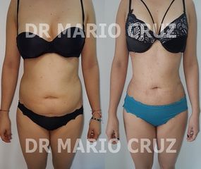 Doctor Mario Cruz Cirujano Plástico - Lipoescultura