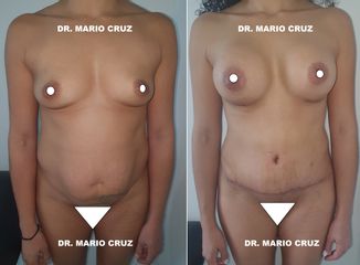 Lipoescultura - Dr. Mario Cruz