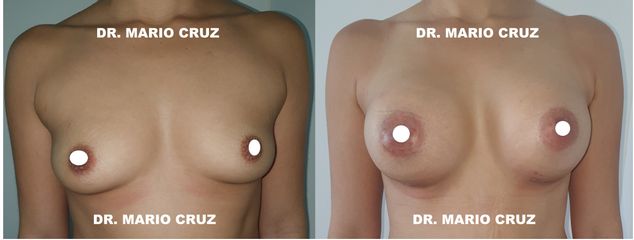 Mamoplastia de aumento - Dr. Mario Cruz