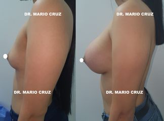 Mamoplastia de aumento - Dr. Mario Cruz
