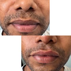 Aumento de labios - Skinbody