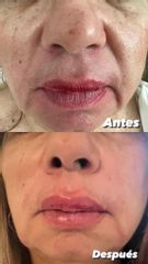 Aumento de labios - Skinbody