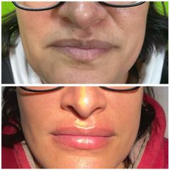 Aumento de labios - Dr. Felipe Galiano