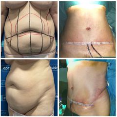 Abdominopastia - Dr. Felipe Galiano