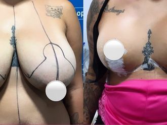 Mamoplastia de reducción antes y después - 863057