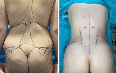 Liposucción - Dr. Felipe Galiano