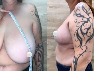 Mamoplastia de reducción antes y después - 863064