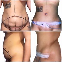 Abdominoplastia - Dr. Felipe Galiano