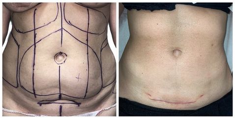 Abdominoplastia - Dr. Felipe Galiano
