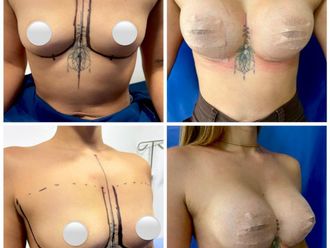 Mamoplastia de aumento antes y después - 874678