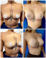 Mamoplastia de Aumento - Dr. Felipe Galiano