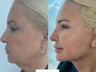 Lifting facial antes y después - 874679
