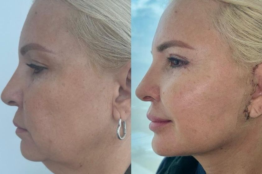 Lifting facial antes y después - 874679