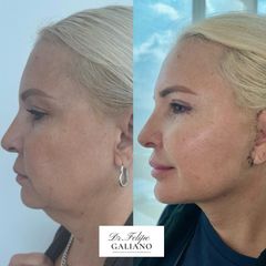 Lifting CervicoFacial - Dr. Felipe Galiano