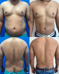 Liposucción - Dr. Felipe Galiano