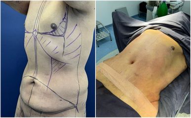 Abdominoplastia - Dra. Mariana Ríos