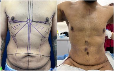 Abdominoplastia - Dra. Mariana Ríos