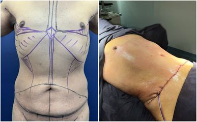 Abdominoplastia - Dra. Mariana Ríos