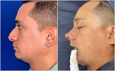 Rinoplastia - Dra. Mariana Ríos