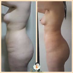 Lipoescultura - Dr. Carlos Bohórquez Ortiz