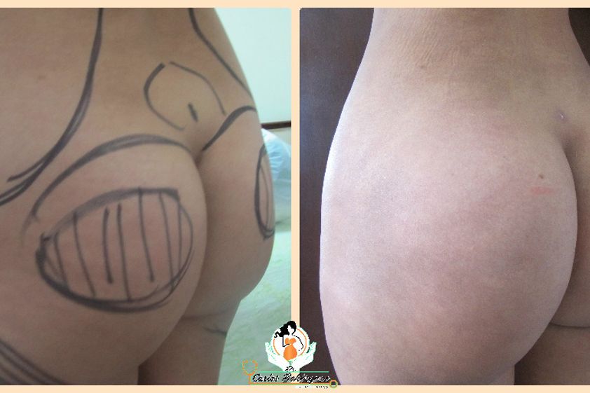 Gluteoplastia antes y después - 738291