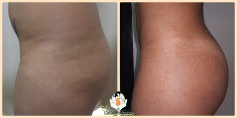 Gluteoplastia - Dr. Carlos Bohórquez Ortiz