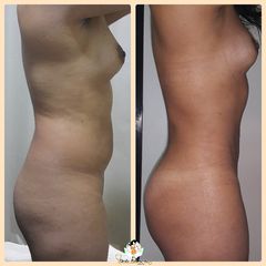 Liposucción - Dr. Carlos Bohórquez Ortiz