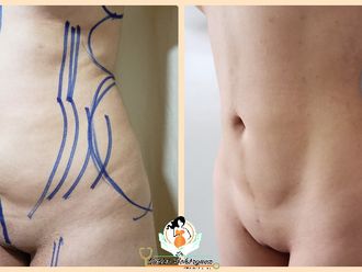 Liposucción antes y después - 738306