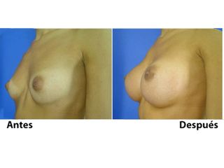 Mamoplastia de aumento